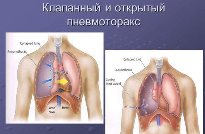 Туберкулёз. Лечение в домашних условиях.!